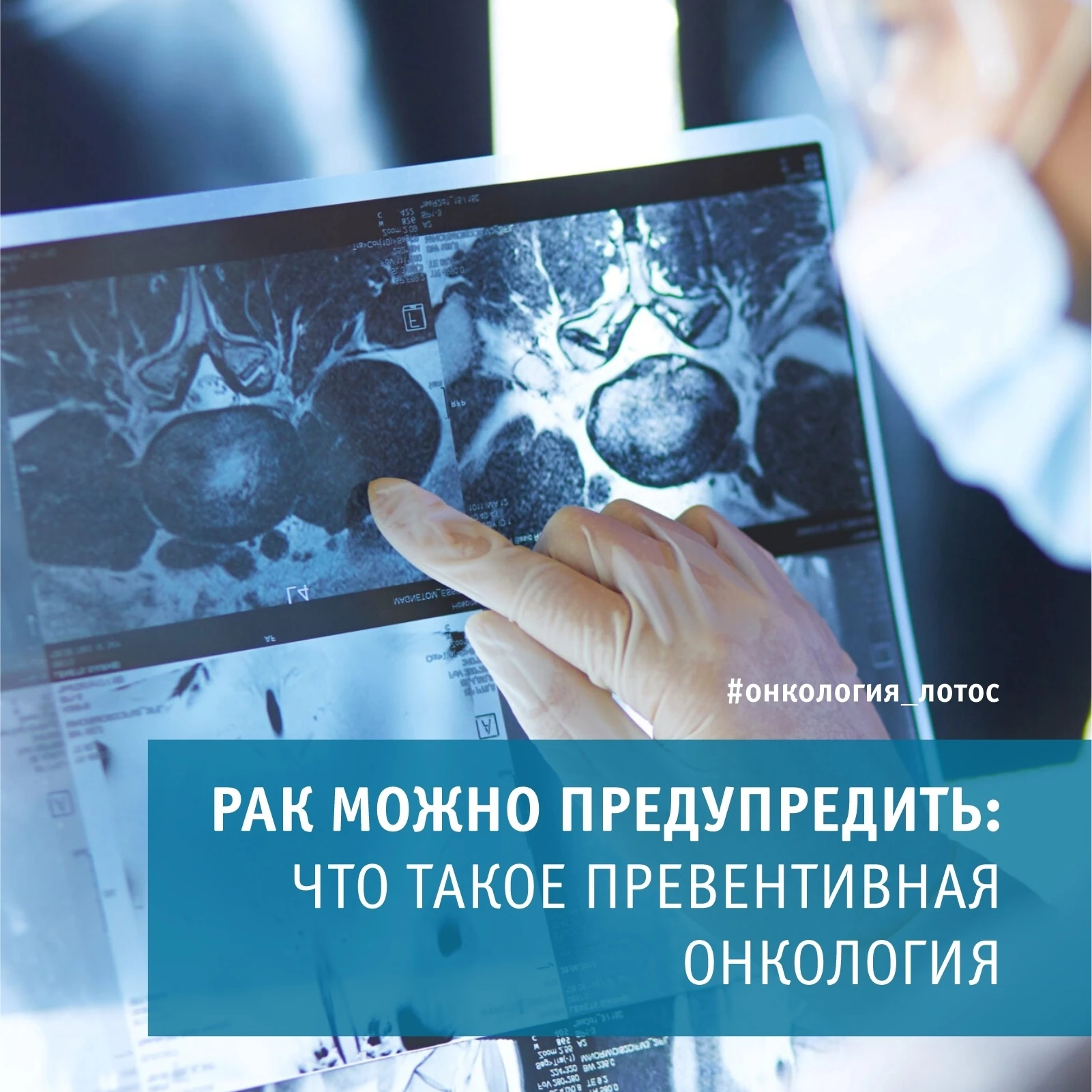 Рак можно предупредить: что такое превентивная онкология