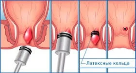 Латексное лигирование Латексное лигирование