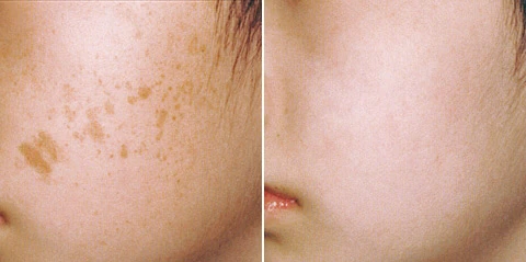 лазер ИЗК до и после