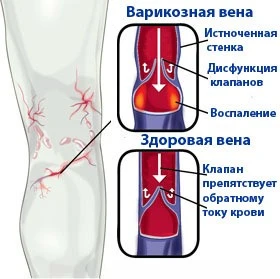 Лечение и профилактика варикозного расширения вен на ногах