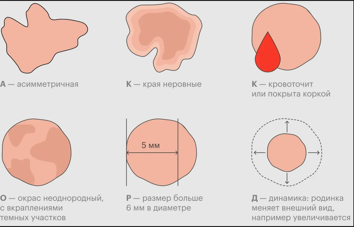 Проверить самостоятельно сомнительную родинку возможно по технике АККОРД -  Новости МЦ «ЛОТОС»