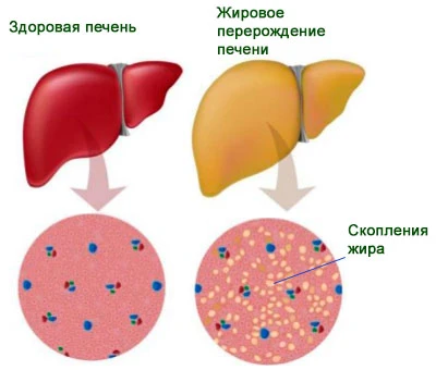 Жировой гепатоз: симптомы и лечение ожирения печени