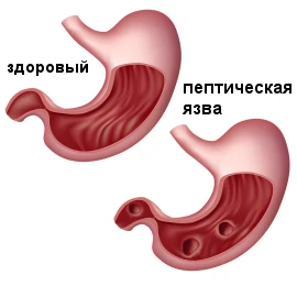 Язва желудка и перстной кишки: симптомы и лечение в Москве в ФНКЦ